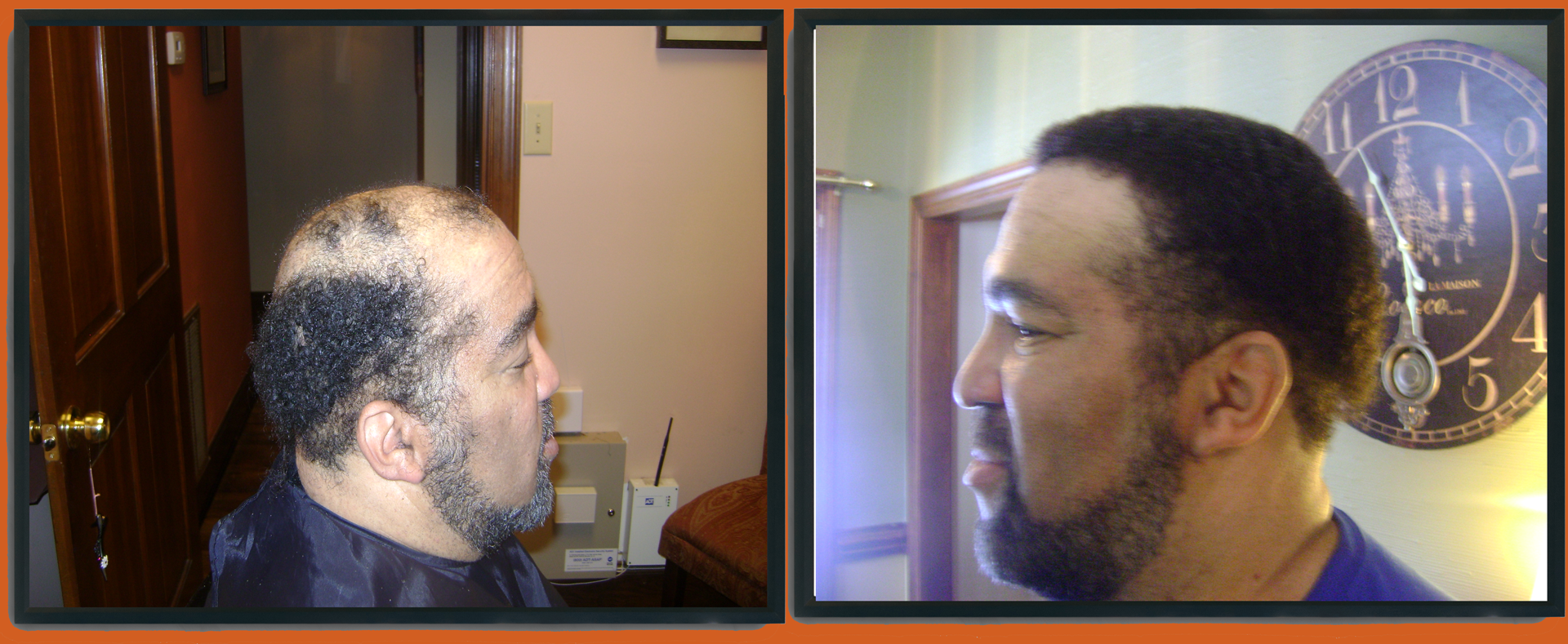 Before After Photos Invisilace Hair Spa